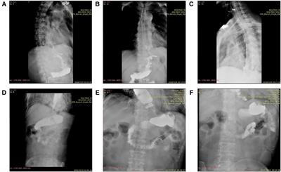 Distal-continual colon interposition for esophageal reconstruction after esophagectomy: Two case reports